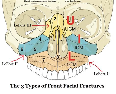 Maxilla Fracture