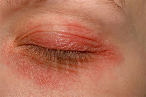 30 Eyelid Dermatitis Stock Photos Pictures And Royalty Free Images Istock