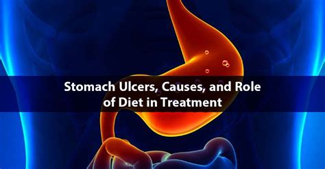 Stomach Ulcers Causes And Role Of Diet In Treatment