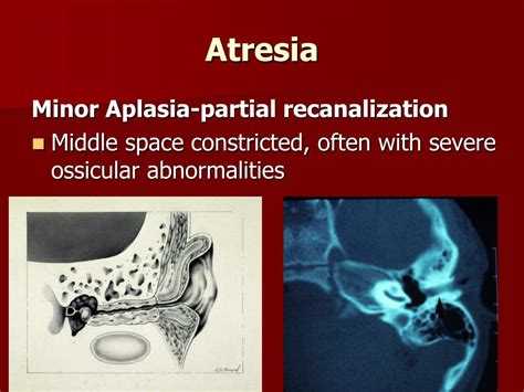 PPT - CONGENITAL AURAL ATRESIA PowerPoint Presentation, free download - ID:1226644