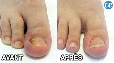 Comment Soigner Un Ongle Incarné Avec Le Remède De Grand Mère