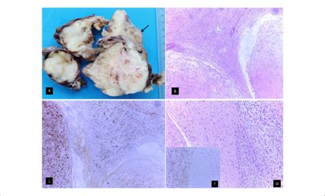 A Macroscopically The Entire Encapsulated Tumor Displayed Fleshy And