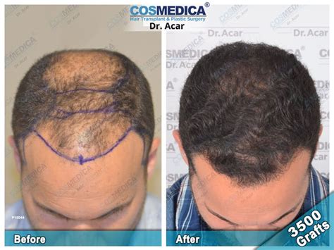 Hair Transplant Turkey Before After Cosmedica Dr Acar