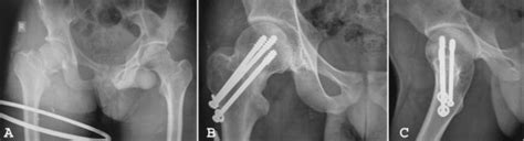 A Anteroposterior Radiograph Of The Pelvis With Both Hips Of A Patient