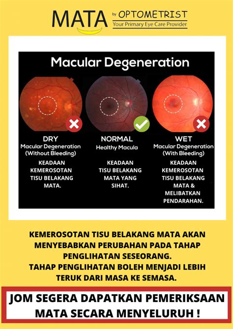 PENYAKIT KEMEROSOTAN TISU BELAKANG MATA MATA By Optometrist