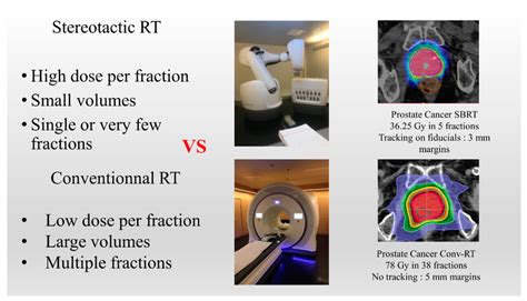 Main Differences Between Stereotactic Radiotherapy And Conventional Download Scientific Diagram