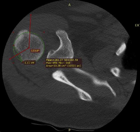 The Bicipital Angle Of A Hill Sachs Lesion Is Determined First We Download Scientific Diagram