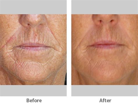 Mouth Wrinkles Before And After Photos