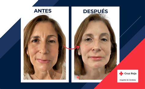 Tratamiento de parálisis facial con Bótox Hospital Cruz Roja de Córdoba