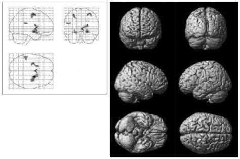 Statistical Parametric Map Illustrating Brain Areas With Increased