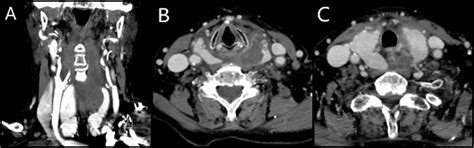 Contrast Enhanced Neck Ct Scan A The Hematoma Appears At The