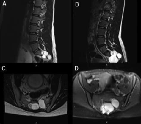 A Large Multilobulated T2 Hyperintense Lesion Consistent With