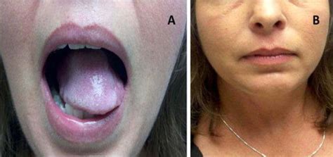 A Free Flap Reconstruction In A 40 Year Old Woman After Transoral Download Scientific Diagram