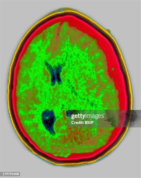 Brain Hematoma Photos And Premium High Res Pictures Getty Images