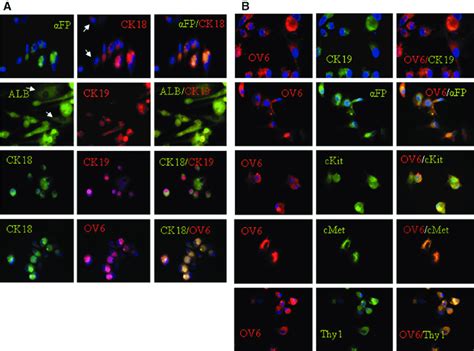 Co Expression Of Hepatic Lineage And Ductular Reaction Markers A