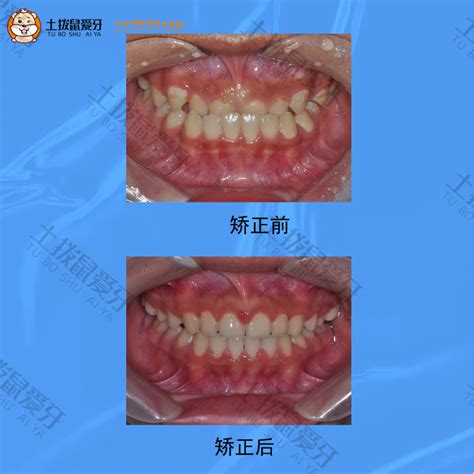 10岁儿童地包天矫正案例 土拨鼠爱牙