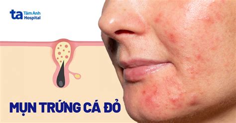 Mụn trứng cá đỏ là gì Nguyên nhân triệu chứng và cách điều trị hiệu quả