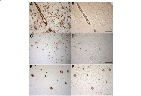 Immunohistochemical staining of amyloid β Aβ 4 x peptides in sporadic