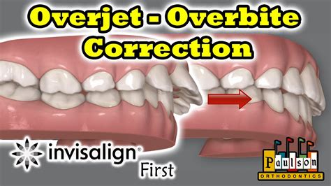 Overjet And Overbite Correction Invisalign First System Instead Of