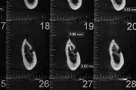 Preoperative Dvt Scan Of A Patient From Inferior Alveolar Nerve Download Scientific Diagram