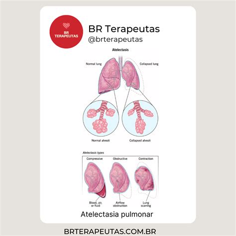 O Que É Atelectasia Pulmonar - O que é a Atelectasia Pulmonar - BR Terapeutas