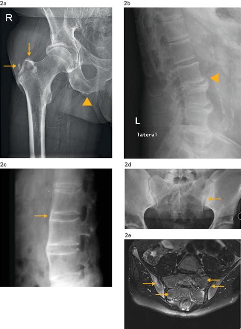 Axial Spondyloarthritis New Advances In Diagnosis And Management The Bmj