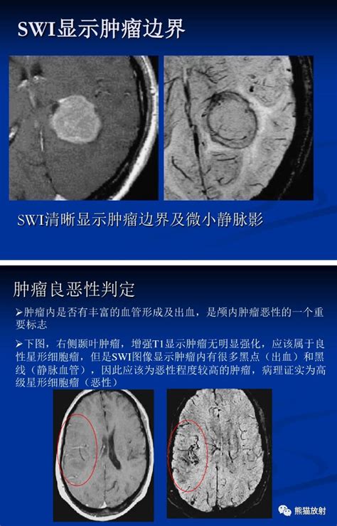 磁共振磁敏感加权成像swi技术原理及临床应用