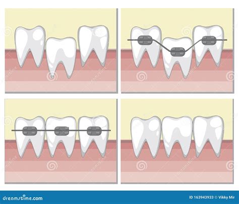 Tanden Met Metalen Beugels Op Het Tandvlees Een Vectorillustratie Met
