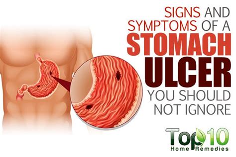 10 Signs And Symptoms Of A Stomach Ulcer You Should Not Ignore Top 10 Home Remedies