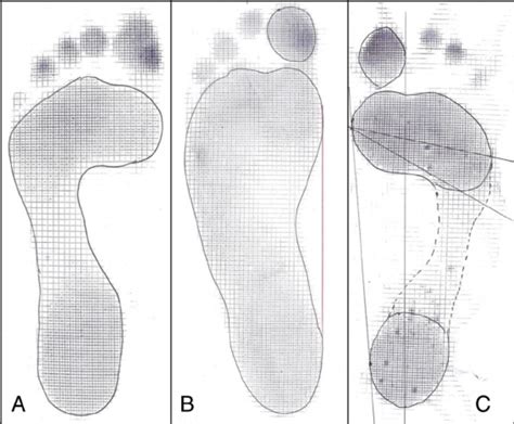 Normal A Broad B And High C Arched Footprint Patterns