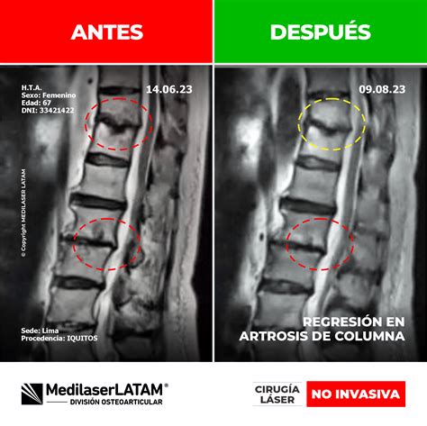 HUGO TENORIO Regresión en Artrosis de Columna Medilaser Perú