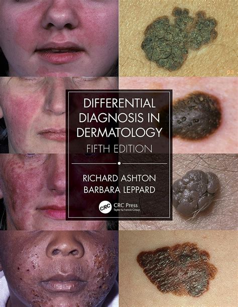 Differential Diagnosis In Dermatology Ashton Richard Leppard Barbara Uk Books