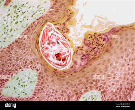 Scabies Light Micrograph Of A Section Through Skin Showing A Scabies