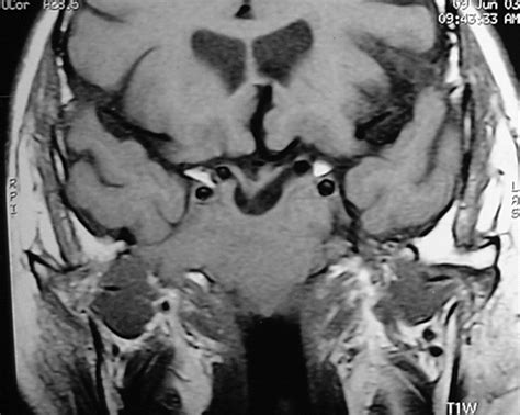 Ectopic Pituitary Adenoma With An Empty Sella Ajr