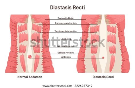 Diastasis Rect Abdominal Muscles Separation Human Stock Vector Royalty