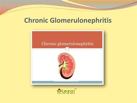 PPT - Chronic Glomerulonephritis: Symptoms, Causes and Treatment PowerPoint Presentation - ID ...