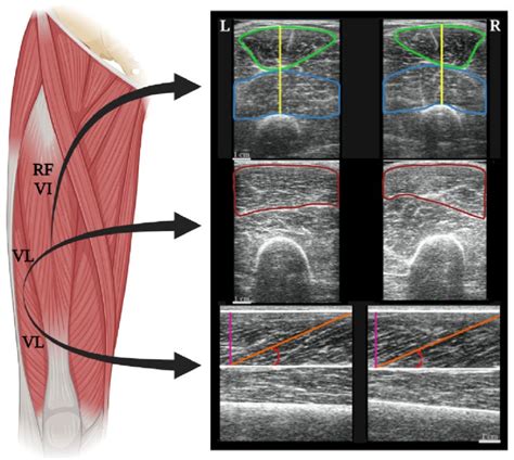 Illustration Of Left L And Right R Quadriceps Muscle Architecture