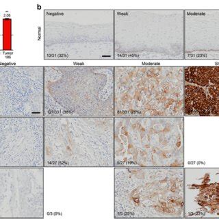 Collagen Xvii Expression In Normal Cervix And Cervical Tumor Tissues