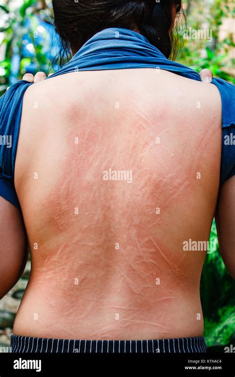 Human Skin Presenting An Allergic Reaction Allergic Rash Stock Photo