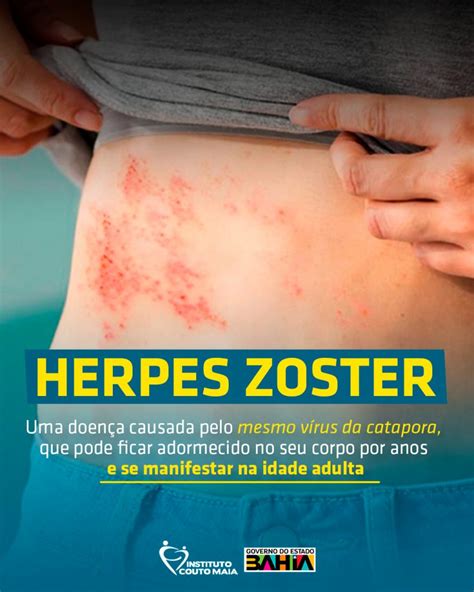 Herpes Zoster Saiba Mais Verloop Io