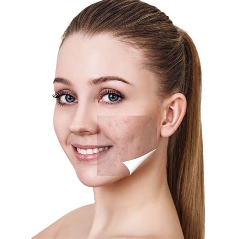 Acne Treatment | Improve Your Skin Aesthetics | Shrewsbury