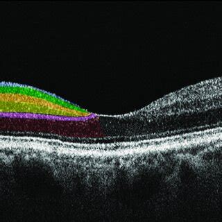 Horizontal Spectral Domain Optical Coherence Tomography SD OCT