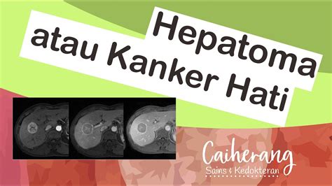 Mengenal Kanker Hati Atau Hepatocellular Carcinoma Hcc Deteksi Sexiz Pix