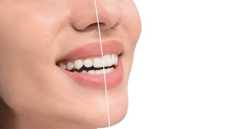 Fixing Gummy Smile With Contouring Procedure And Cost Wahroonga