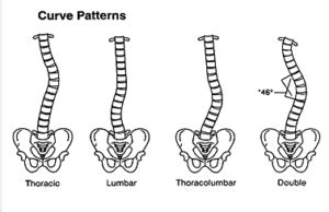 Scoliosis Treatment Options