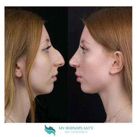 Naso Rifatto Prima E Dopo Casi Di Rinoplastica My Rhinoplasty