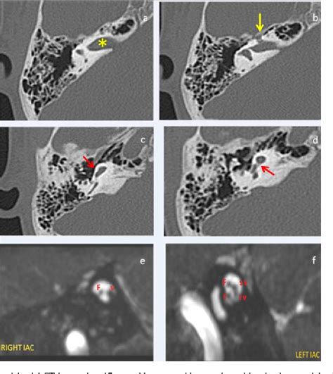 Figure 11 From Temporal Bone Congenital Anomalies And Variatons