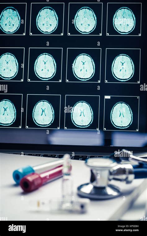 Risonanza Magnetica Del Cervello Normale Immagini E Fotografie Stock Ad