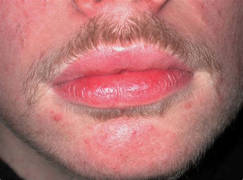 Patient 18 With Granulomatous Cheilitis Moderate Improvement Of Lip