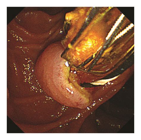 Endoscopic Retrograde Cholangiography Images Cholangiogram Revealed No